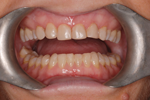 Cosmetic Lower Teeth Done