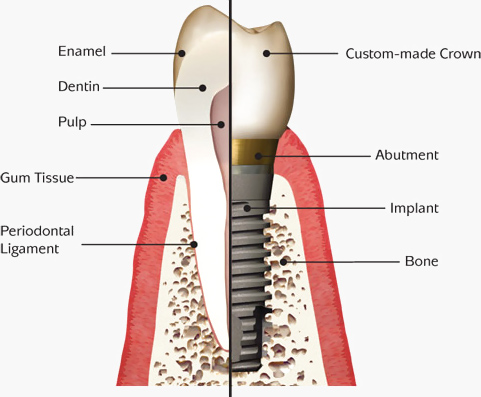 Dental Implant